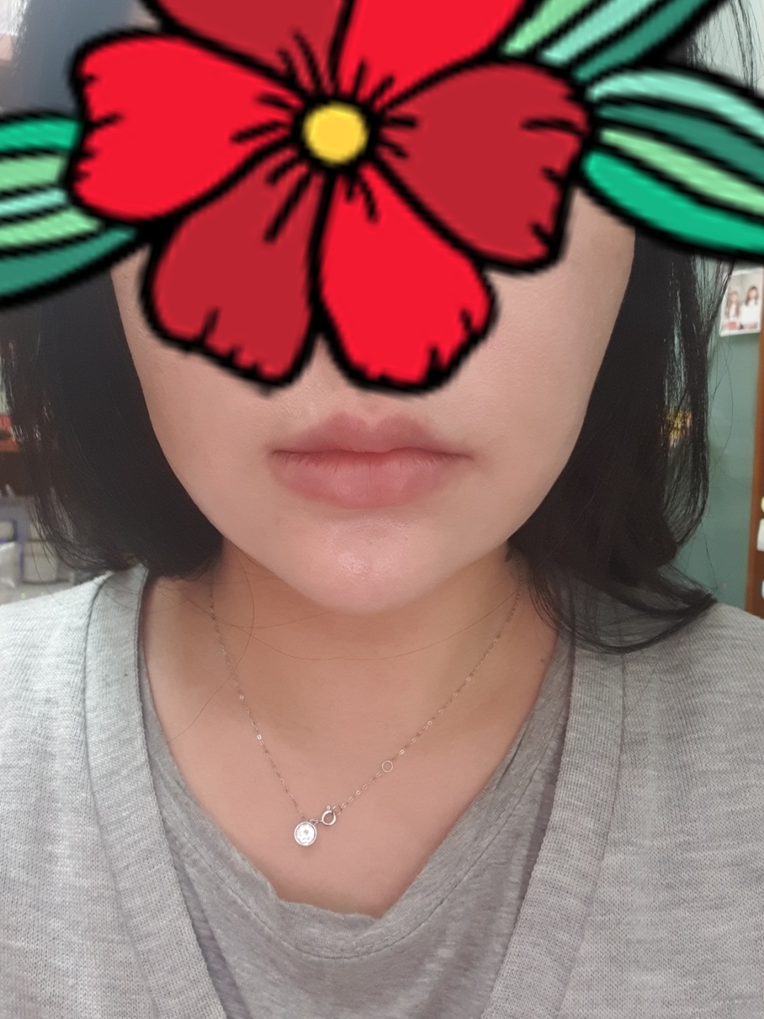 입꼬리성형 후기