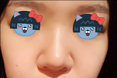 콧볼축소 후기