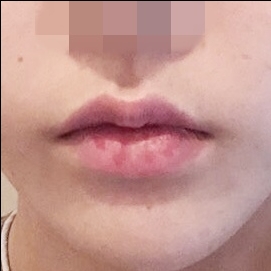 입꼬리성형 후기