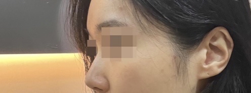 코(귀연골) 후기