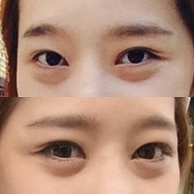밑트임 후기