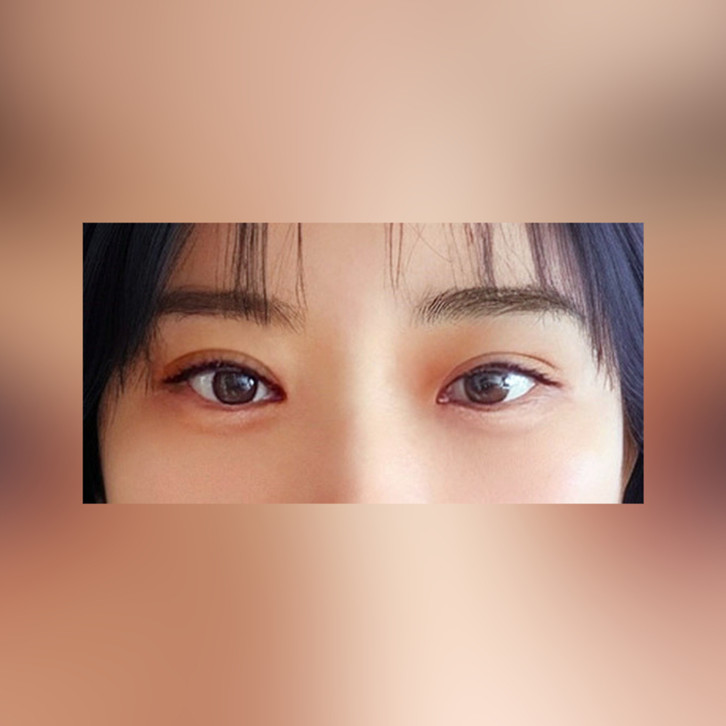 눈재수술 후기