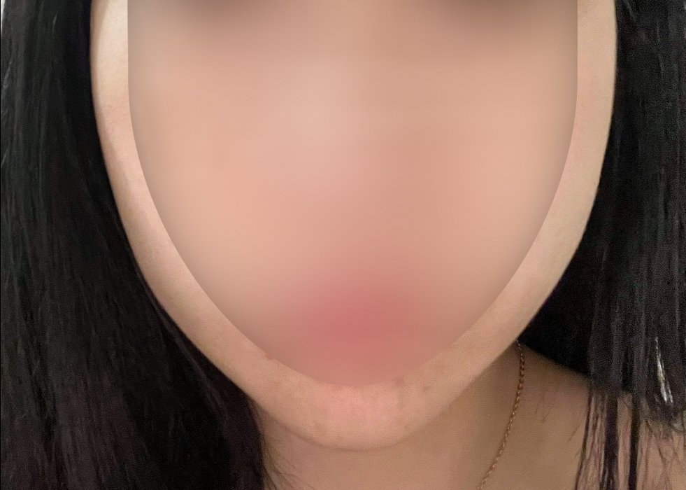 윤곽주사 후기