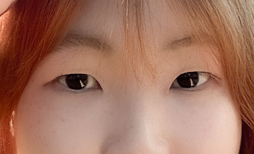 쌍꺼풀(자연유착) 후기