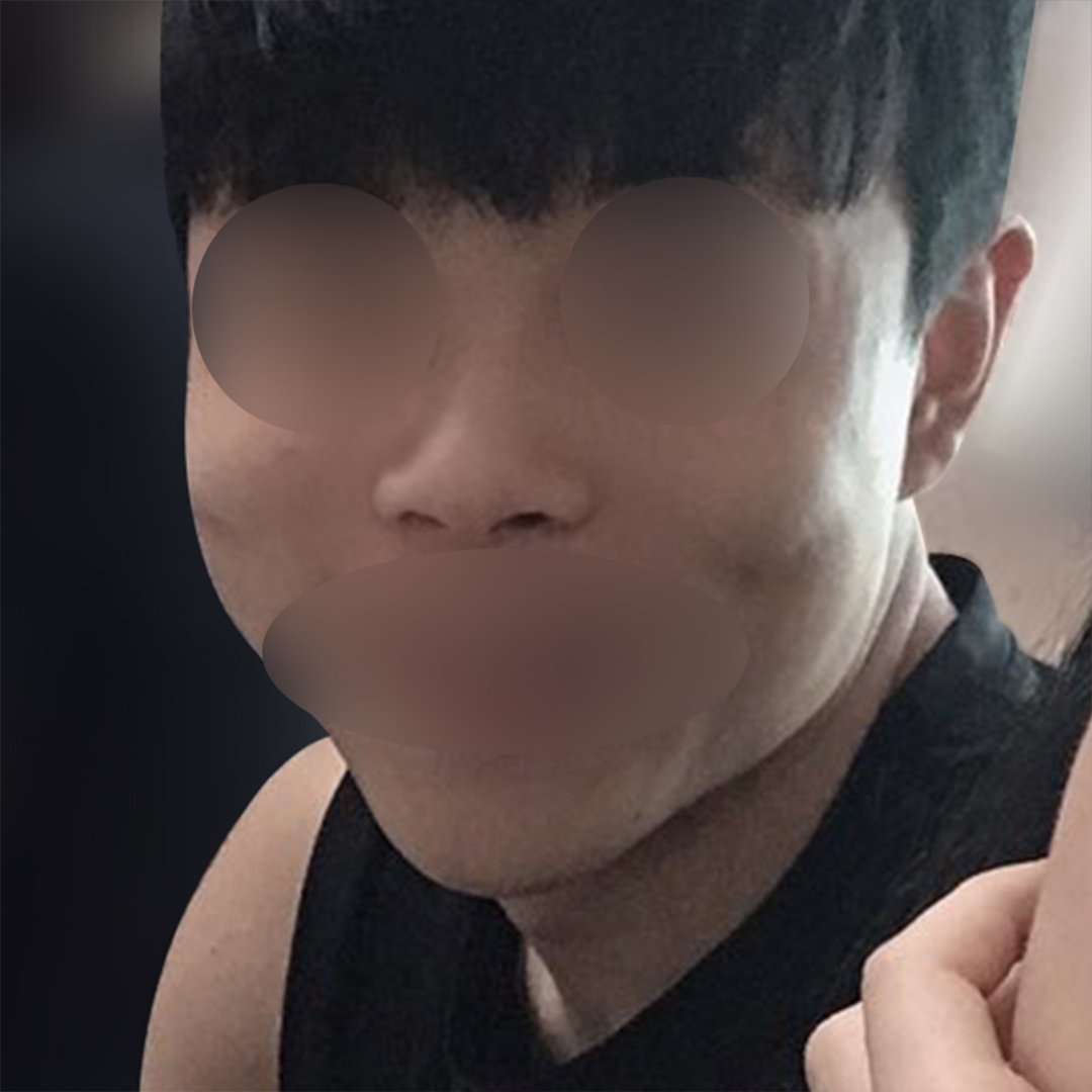 코끝(기증연골) 후기