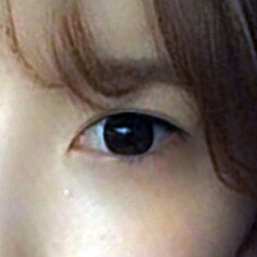 눈재수술 후기