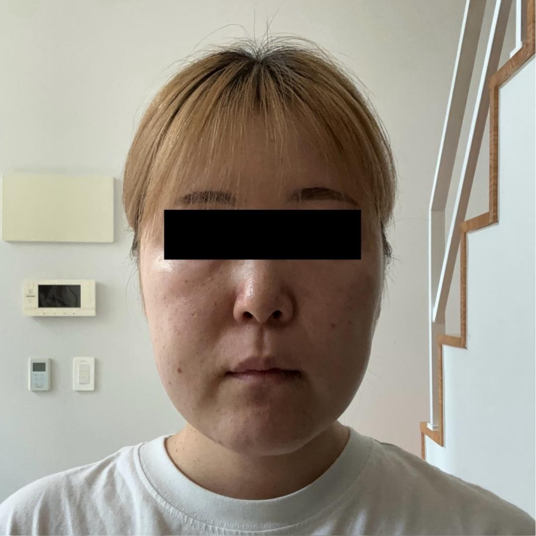 얼굴지방분해주사 후기