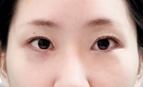 밑트임 후기