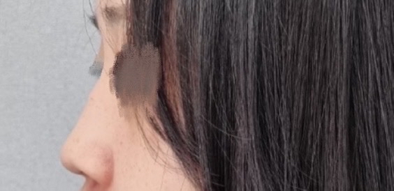 코절골술 후기