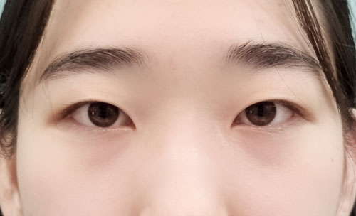쌍꺼풀(자연유착) 후기
