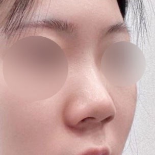 복코성형 후기