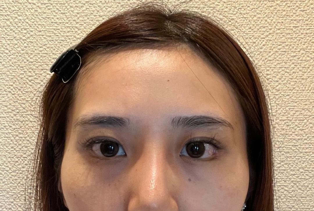 눈밑지방재배치 후기