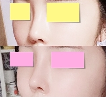 코끝(자가연골) 후기