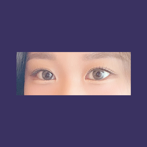 눈재수술 후기
