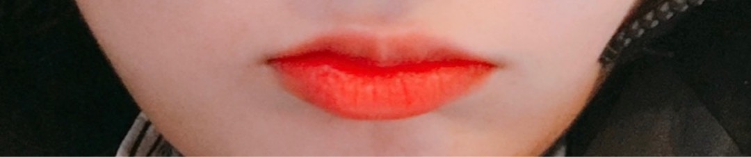 입꼬리성형 후기