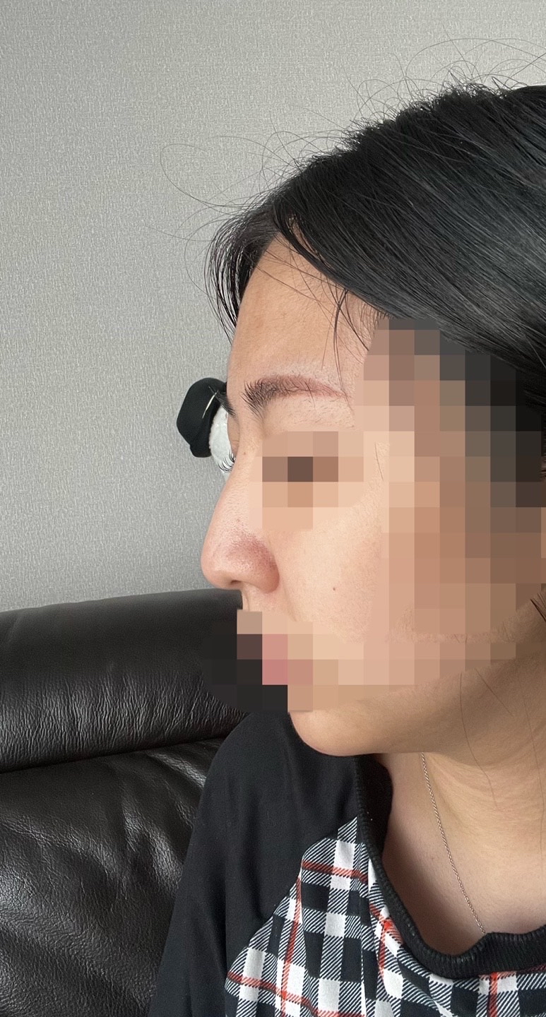 코끝(자가연골) 후기