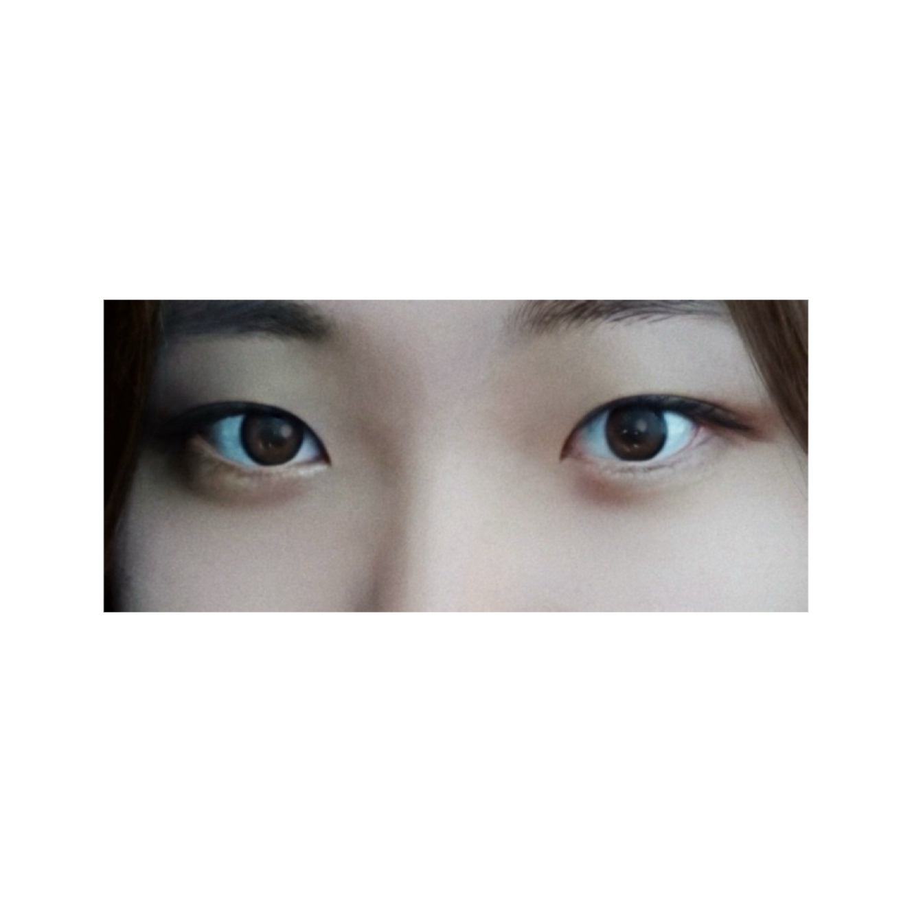 눈재수술 후기