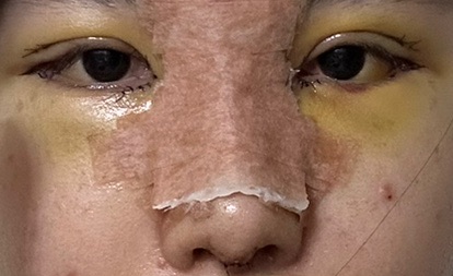 쌍꺼풀(절개) 후기