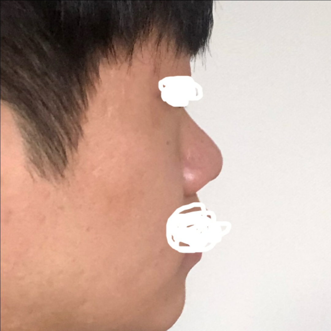 코끝(자가연골) 후기