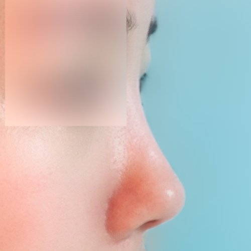 코재수술 후기
