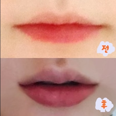 입꼬리성형 후기