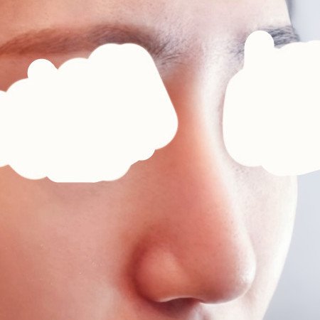 콧대(보형물) 후기