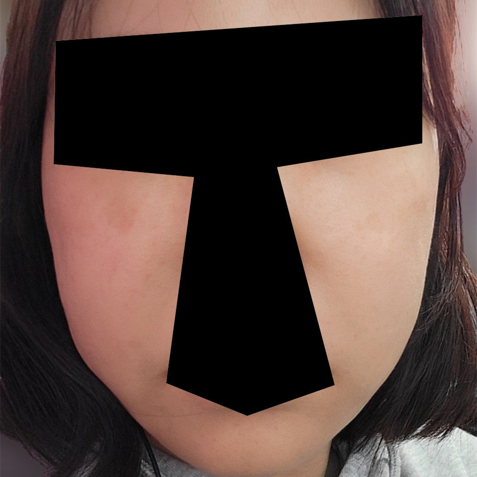 실리프팅 후기