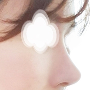 코끝(자가연골) 후기