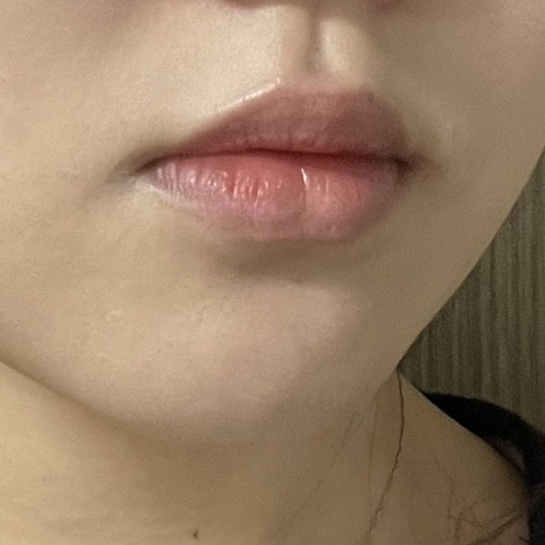입꼬리성형 후기