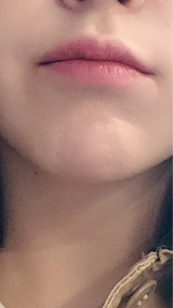 입꼬리성형 후기