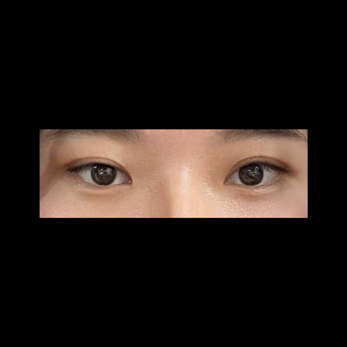 밑트임 후기