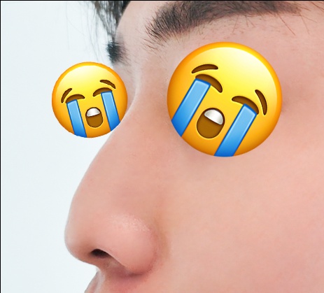 코끝(자가연골) 후기