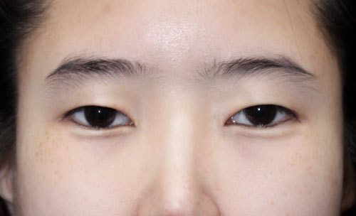 쌍꺼풀(자연유착) 후기