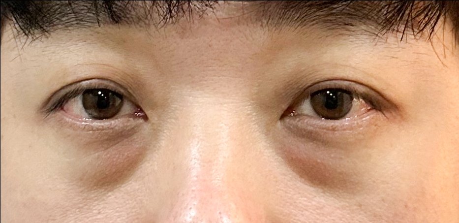 눈밑지방재배치 후기