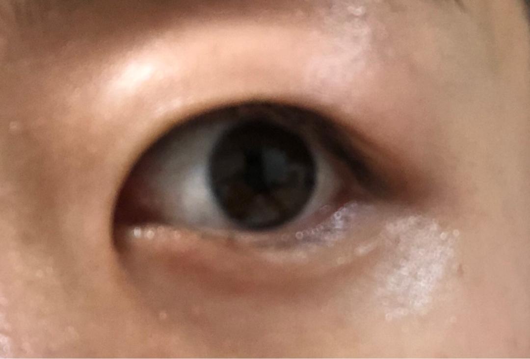 쌍꺼풀(절개) 후기