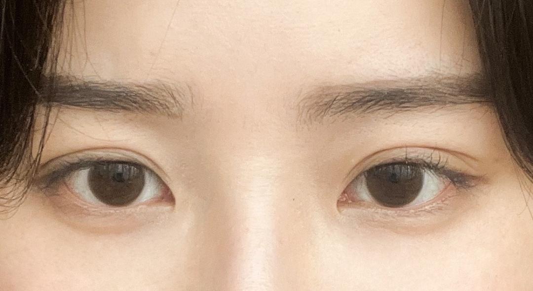 입꼬리보톡스 후기