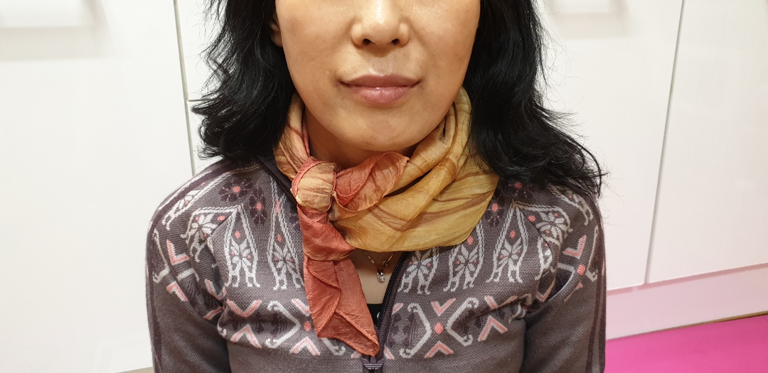 입꼬리성형 후기