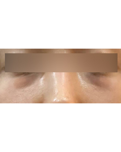 눈밑지방재배치 후기