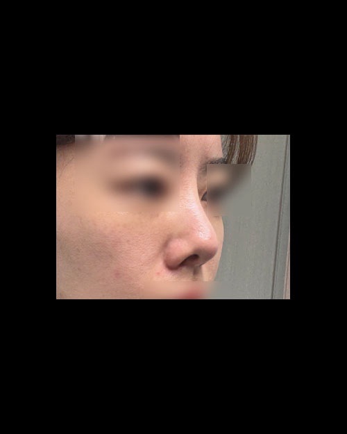 코끝(자가연골) 후기