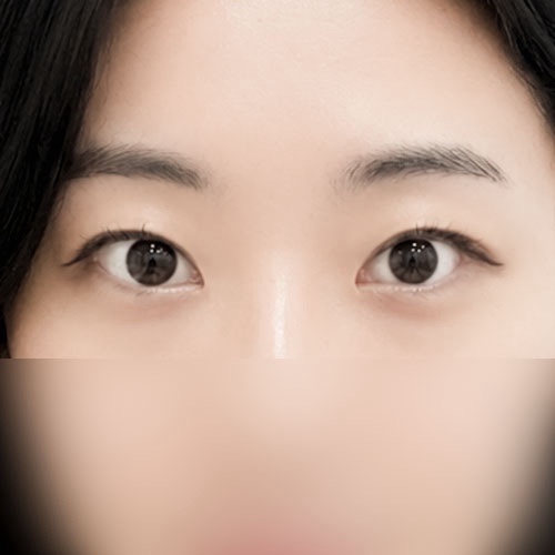 밑트임 후기