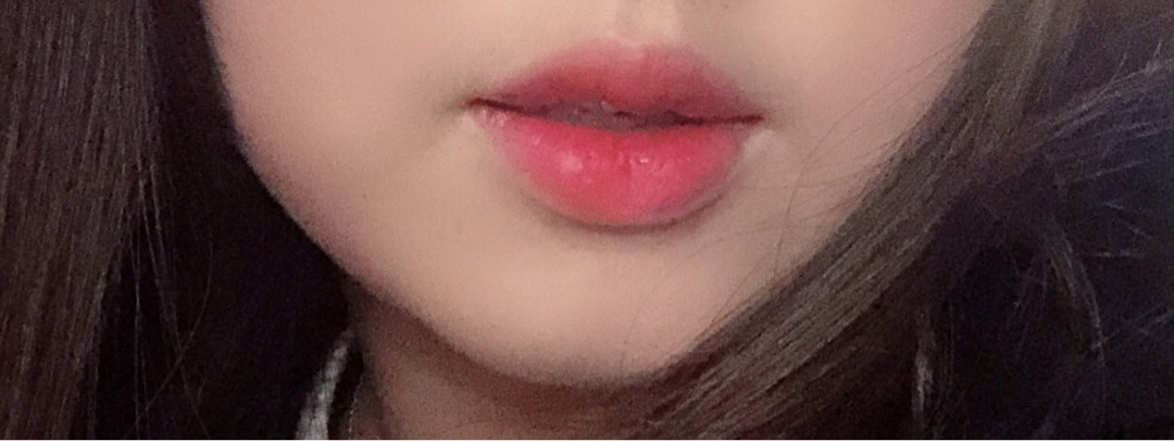 입꼬리성형 후기