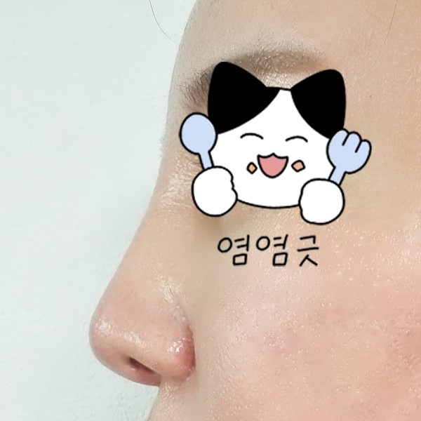코재수술 후기