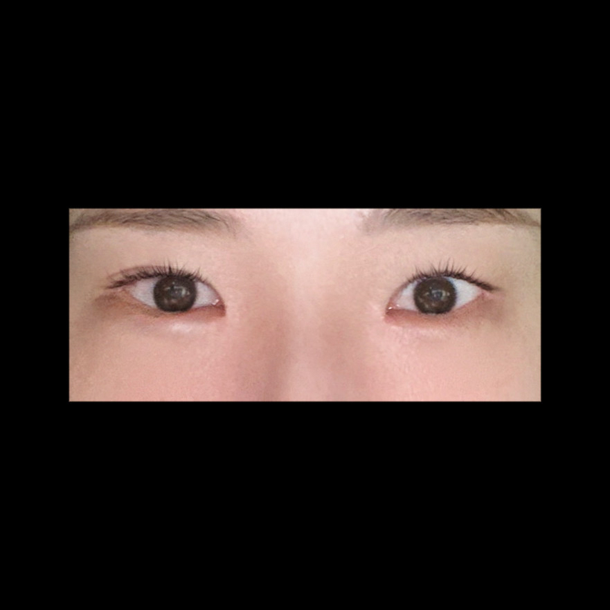 쌍꺼풀(절개) 후기