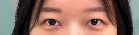 눈재수술 후기