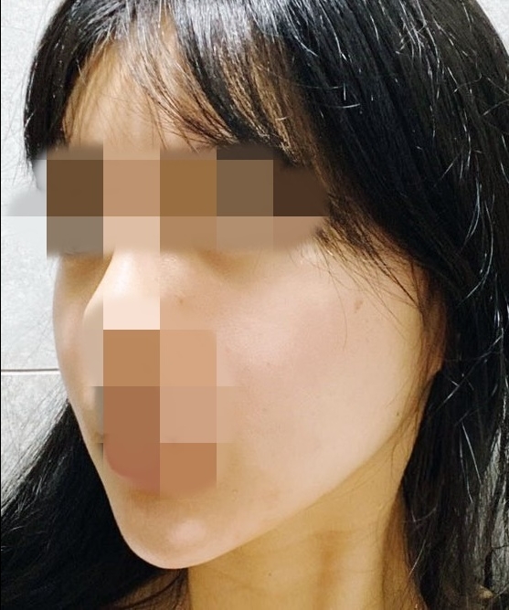 광대축소(앞광대) 후기