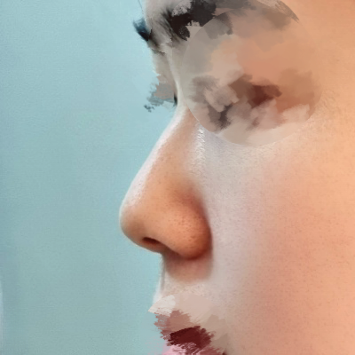 코끝(기증연골) 후기