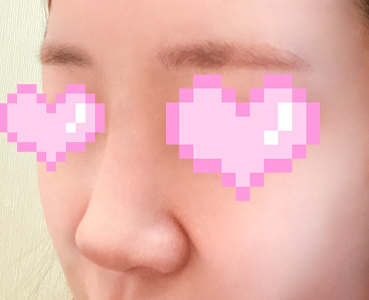 콧대(자가조직) 후기