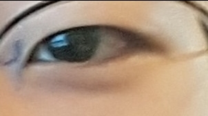 쌍꺼풀(절개) 후기