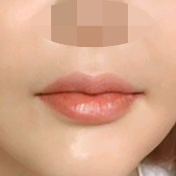 입꼬리성형 후기