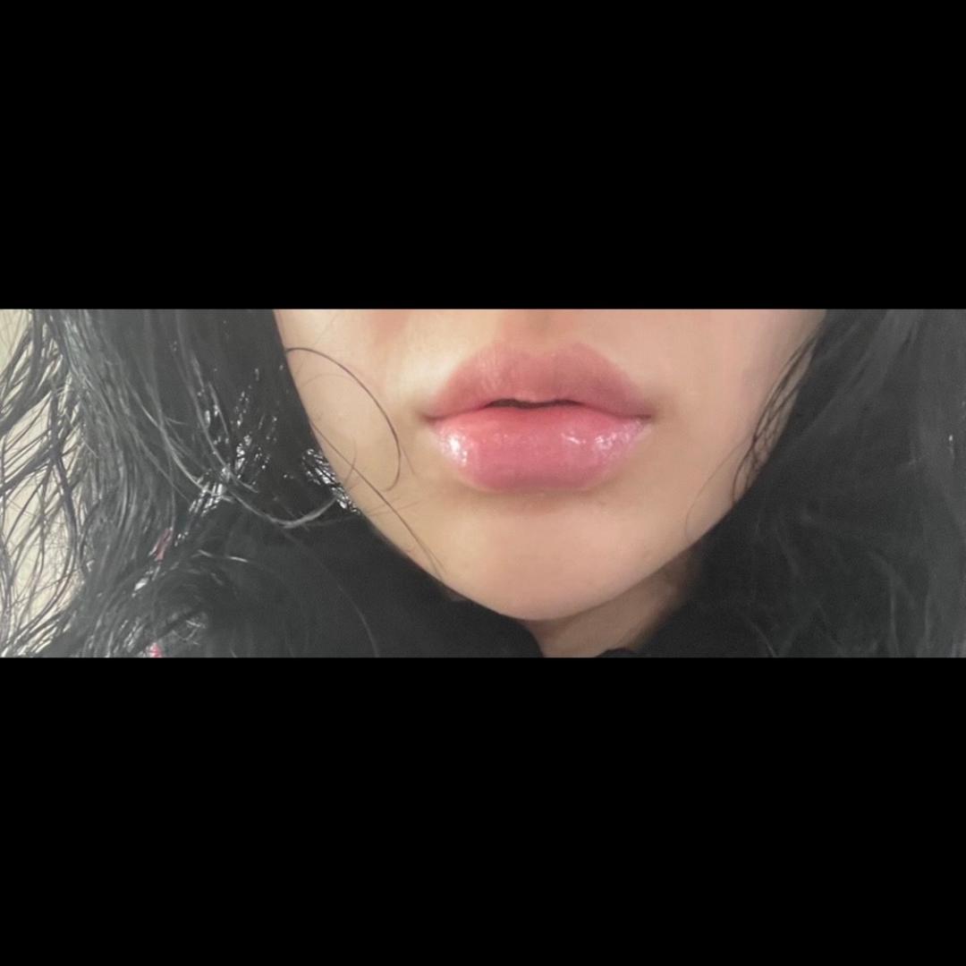 입꼬리성형 후기